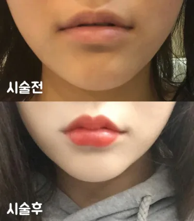 [Жижиг] bobommm - Уруулын филлер