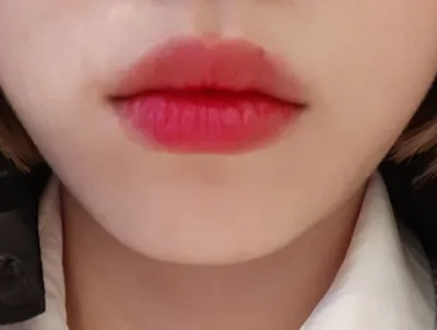 [Бяцхан] Диарупа - Филлер, Ботокс