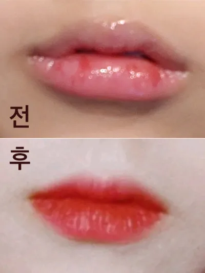 [Жижиг] Уруулын дүүргэлт - Филлер, ботокс