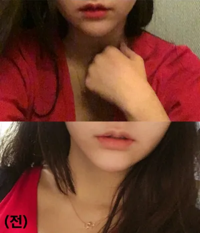 [Бяцхан] ghyghy - Уруулын филлер