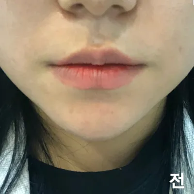 [Жижиг] Дотторуя - Уруулын филлер, ботокс