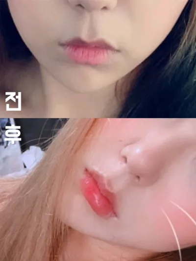 [Бяцхан] Чичике - Уруулын филлер