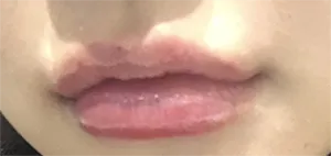 [Гоо сайхны бяцхан мэс засал] Мухани - Уруул