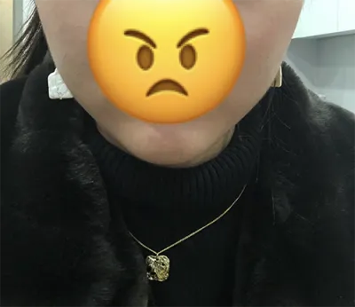 [Жижиг] Минжани - Ботокс, эрүүний үзүүрийн филлер