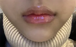 [Жижиг] Гоо сайхны мэс засал - Уруул