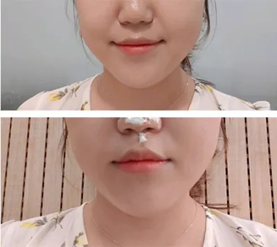 [Арьс] Доттнури - Утасан лифтинг, Шринк