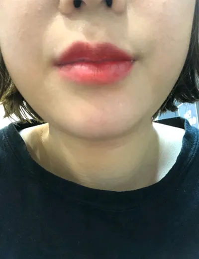 [Бяцхан] Ид шидийн гүнж - Уруулын филлер