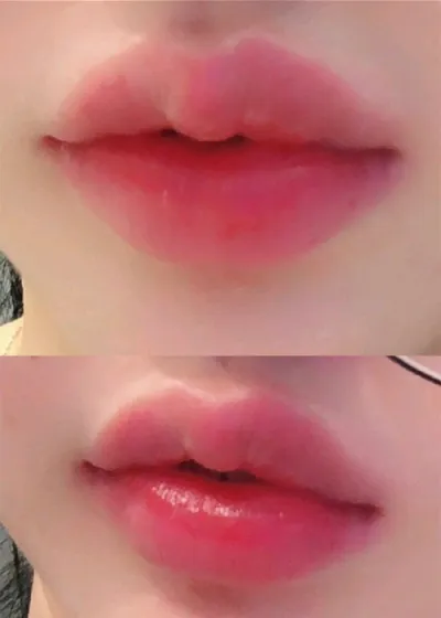 [Бяцхан] ЮнЮнЮнЮнЮнЮн2 - Уруулын филлер