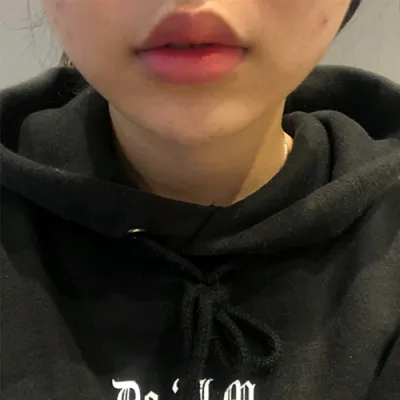 [Жижиг] А1 залхуутай кк - Уруулын филлер