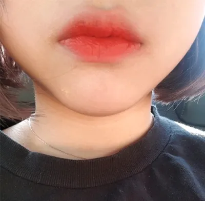 [Жижиг] awdrgyj - Уруулын филлер, ботокс