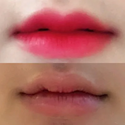 [Бяцхан] sodh - Уруулын филлер