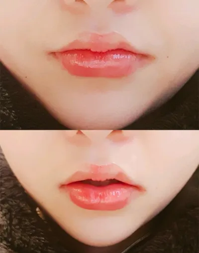 [Жижиг] Ким гүнж, - Уруулын филлер, ботокс