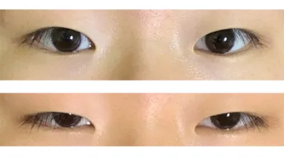 [Нүд] Бяцхан - Нүд