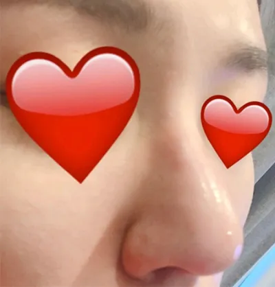 [Жижиг] 2080 Чияаку - Хамрын барималжуулах тариа, Ботокс