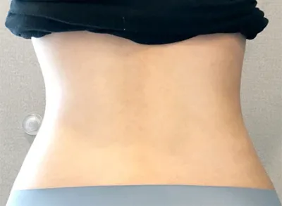 [Өөх соруулах] Ggultabin - Хөл, хэвлийн өөх соруулах