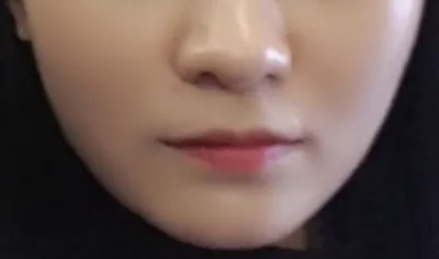 [Бяцхан] Сүбини-гийн ts - Уруулын филлер