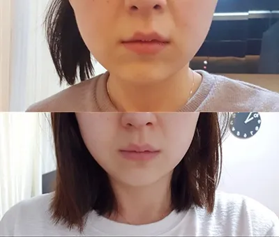 [Жижиг] deinmm - Шүрүнк, Контур Токс