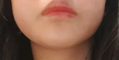 [Арьс] Гыдан - Лазер лифтинг