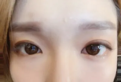 [Нүд] Мэс заслын тойм - Нүд