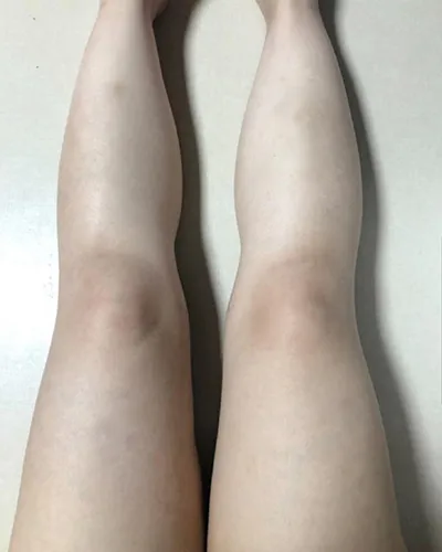 [Өөх соруулах] zz0808 - Шилбэ, гуяны өөх соруулах