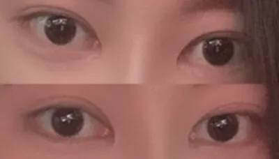 [Нүд] Дучисс - Нүдний дахин мэс засал