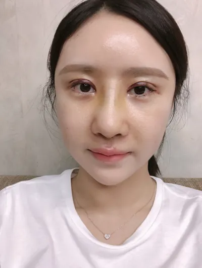 [Хамрын мэс засал] Je নিউbl리 - Нүд, Хамар