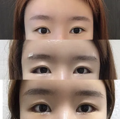 [Нүд] Нананинан - Ар, доод зовхины тайралт