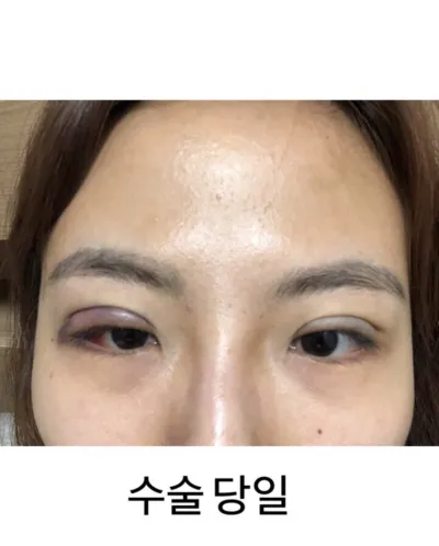 [Нүд] Сүри8536 - Нүдний хэлбэр засах