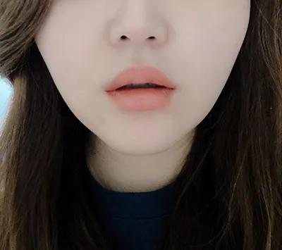 [Бяцхан] Блин-ий - Уруулын өнцөгт ботокс, Уруулын филлер