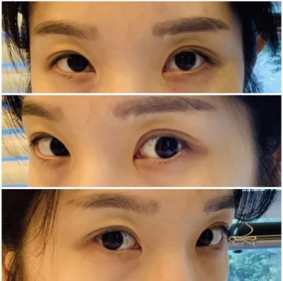 [Нүд] Ттадданбли - Урд зүсэлт, Дээд зүсэлт