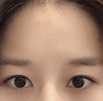 [Нүд] Шүнгюн - Арьсны өө сэв арилгах, Доод зовхины унжралт арилгах