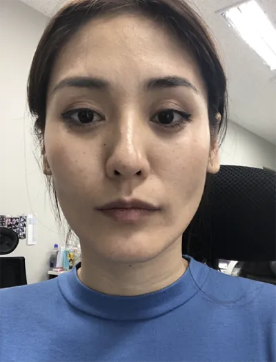 [Хөгшрөлтийн эсрэг] Намона - Нүүрний бүх хэсэгт өөх шилжүүлэн суулгах