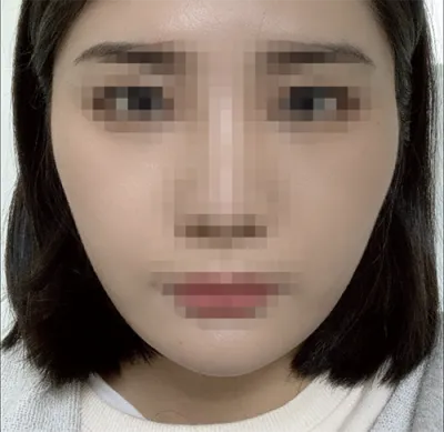 [Нүүрний контур] Ойингаа - Нүүрний контур, хамар, өөх шилжүүлэн суулгах