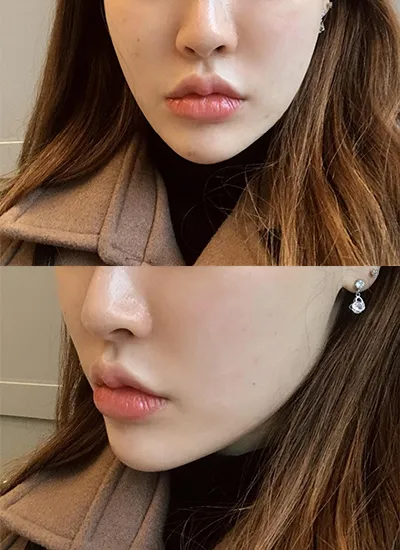 [Арьс] Гоё сайхан болмоор байнаа - Шринк, Контур ботокс