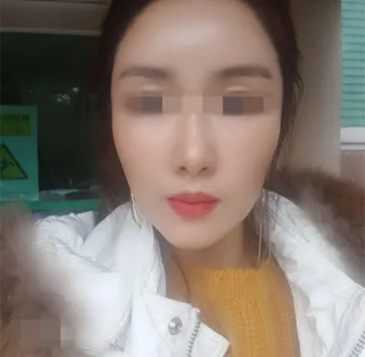 [Хөгшрөлтийн эсрэг] Бинбинийн гэр - Нүүрний өөх шилжүүлэн суулгах