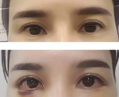 [Нүд] Санкэмигэрл - Доод зовхины тайралт, арьс суллах мэс засал