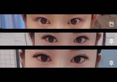 [Нүд] Сөбли9999 - Доод зовхины тайралт, Арьсны тайралт