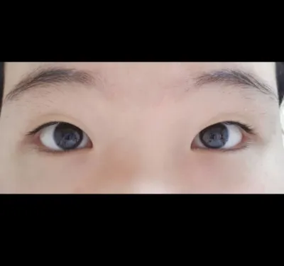 [Нүд] Сөү Юн - Булчингүй оёдол, урд зүсэлт