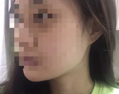 [Бяцхан] Нинанангйиинг - Өөх задлах тариа, Лифтинг