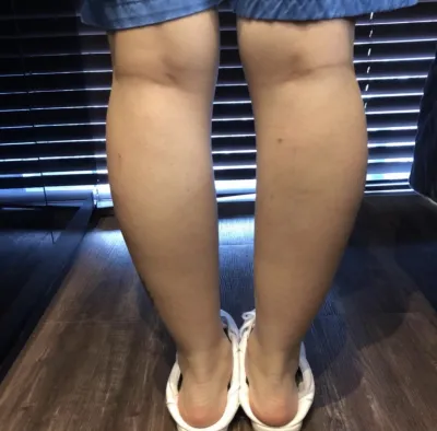 [Жижиг] Бөөн - Ботокс, Өөх задлах тариа