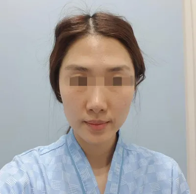 [Бяцхан] Бинбингийн гэр - Нүүрний бүх хэсэгт өөх шилжүүлэн суулгах