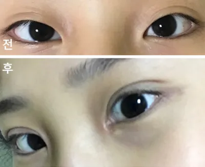 [Нүд] solmdd - Урд зүсэлт, Нүдний хэлбэр засах