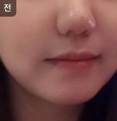 [Арьс] oy1004 - Лифтинг, Усан гялбааны тариа