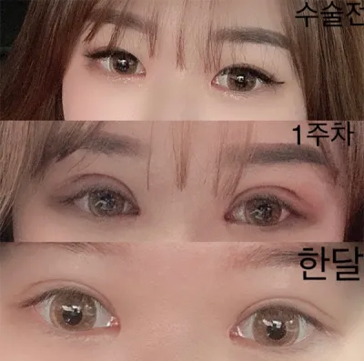 [Нүд] Росион - Дээд зовхины нээлт, Нүдний хэлбэр засах, Давтан мэс засал