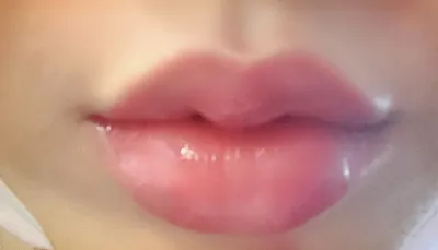 [Бяцхан] Жинхэнэ 2 - Уруулын филлер