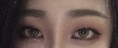 [Нүд] Хайхыйны - Доод зовхины тайралт, Арьс тайралт