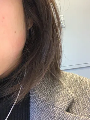 [Жижиг] Меланхолийн улирал - эрүүний ботокс