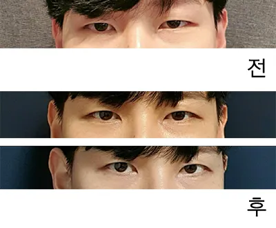 [Нүд] WDHH - Нүдний хэлбэр засах