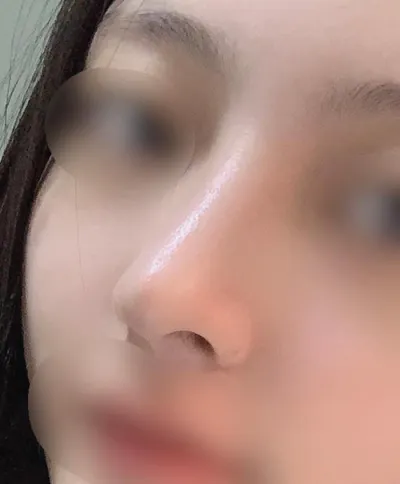 [Хамрын мэс засал] Жүби0111 - Хамар