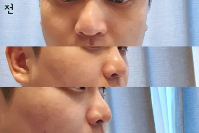 [Хамрын мэс засал] sh1987 - Хамар